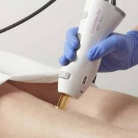 alessandrite laser candela manipolo trattamento gambe milano